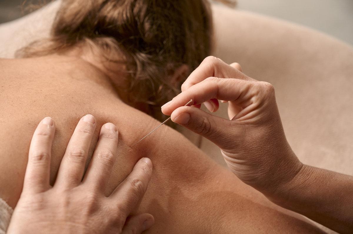 Dry needling impressie